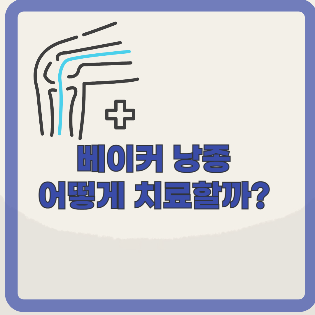무릎 뒤쪽의 물혹, 베이커 낭종의 증상과 관리법 확인하기