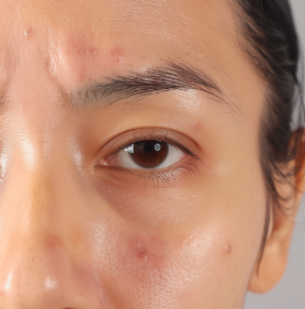 피지선 증식증 연고3