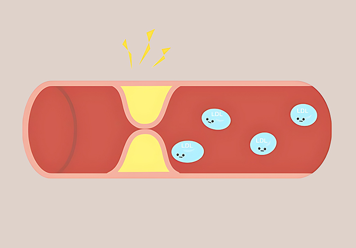 관상동맥-질환이-있는-혈관의-모습