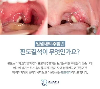 입냄새 제거방법 증상 원인_12