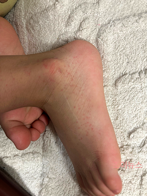 수족구 증상이 보이는 아이의 발