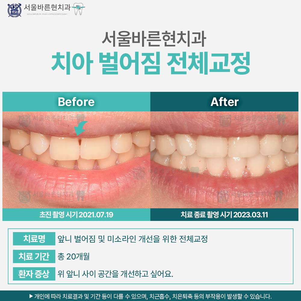 부산치아교정