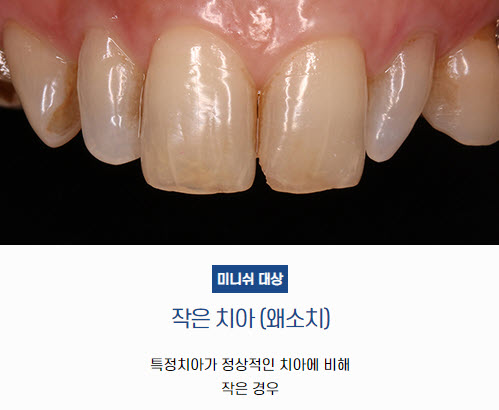 작은치아