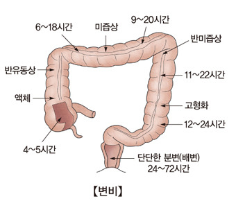 변비 이미지