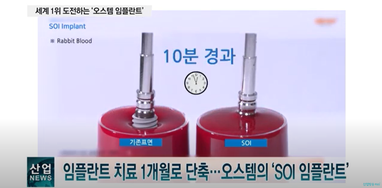 SOI 임플란트는 치료를 1개월 단축시킵니다.