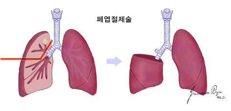 폐암수술의 방법