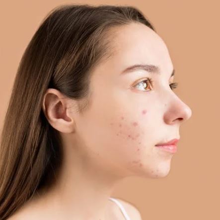 여드름 빨리 없애는 법 원인 증상