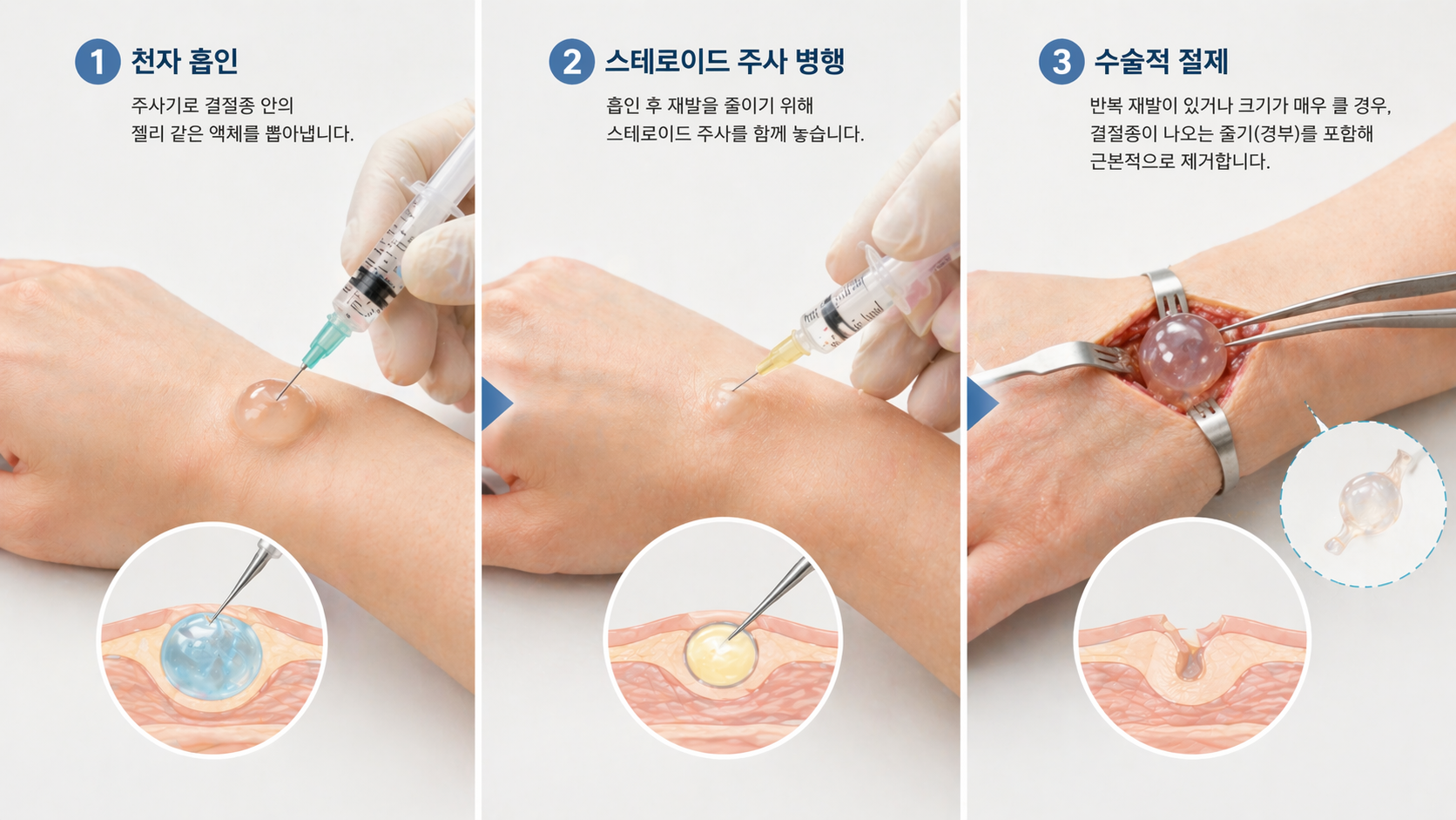 손목 결절종(양성 낭종, 자가 진단, 치료 선택)