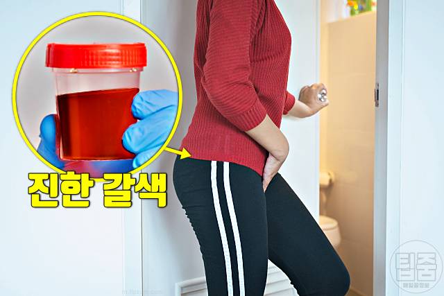 췌장암 의심증상 소변색 췌장암 생존율 낮은 이유