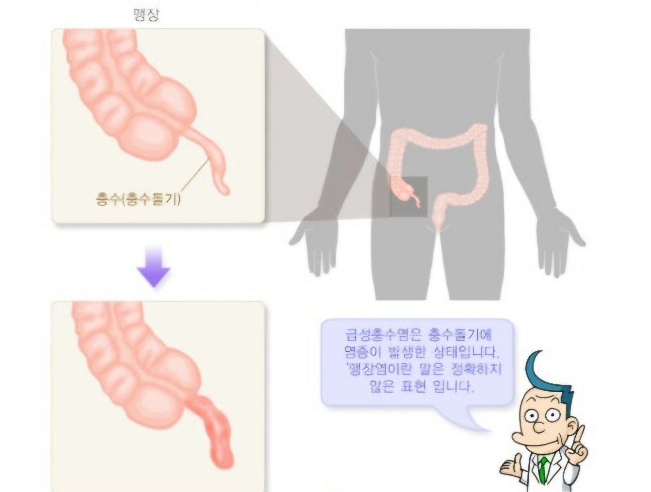 맹장(충수돌기)의 위치를 알려주는 사진