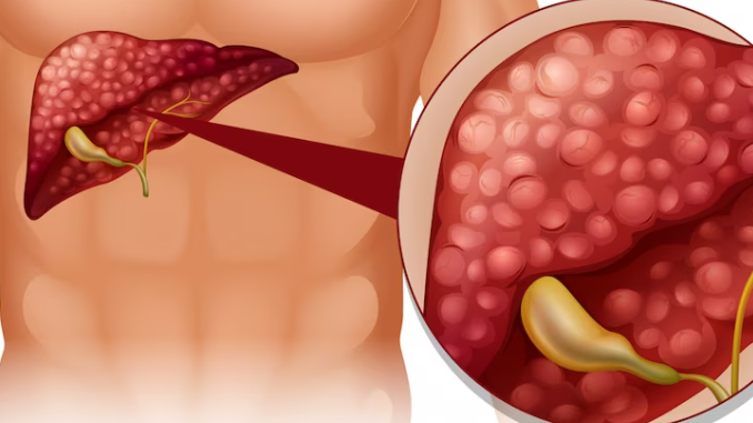 담도 폐색을 치료하는 방법