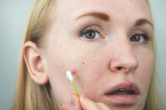 여드름 연고 종류 &amp; 추천 &ndash; 효과적인 여드름 치료법