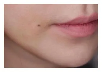 점생기는 이유