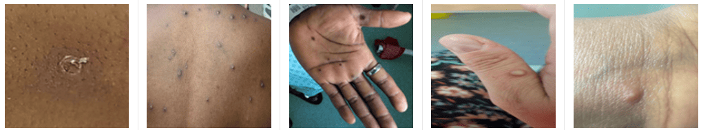 엠폭스 감염으로 인한 발진 사진