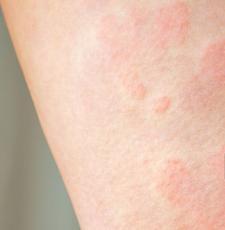 한랭두드러기 증상