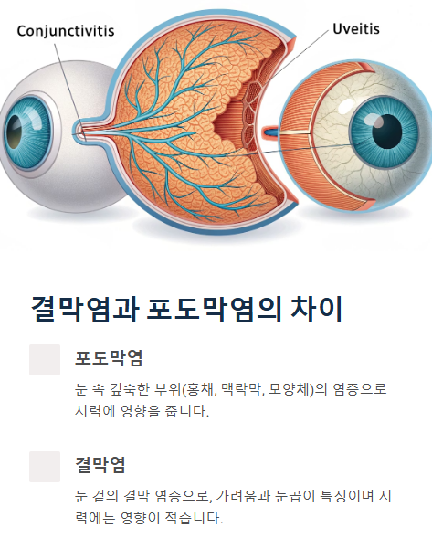 결막염과 포도막염의 차이