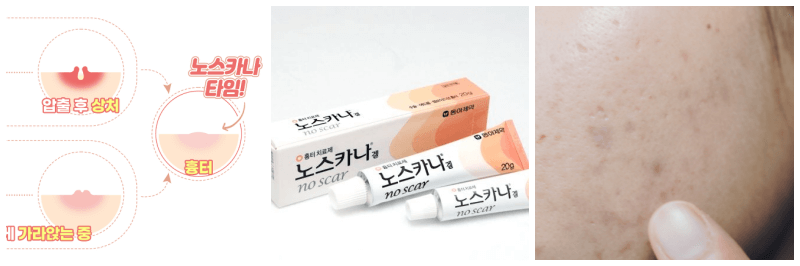 노스카나겔 바르는 시기, 노스카나겔, 여드름 흉터 사진