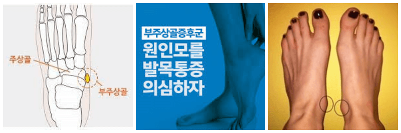 부주상골 증후군 사진 3개