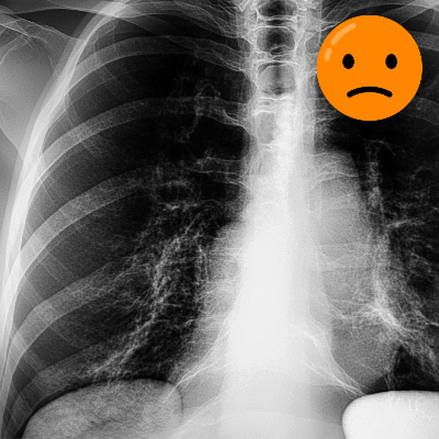 왼쪽 가슴 통증 원인