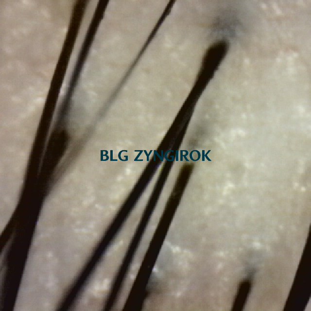 탈모 극복 프로젝트 - 탈모약 복용 33주차 뒷머리 두피사진 모습이다.