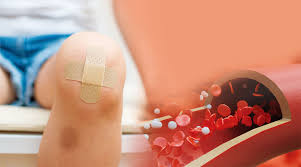 멍이 잘 드는 이유와 예방 방법