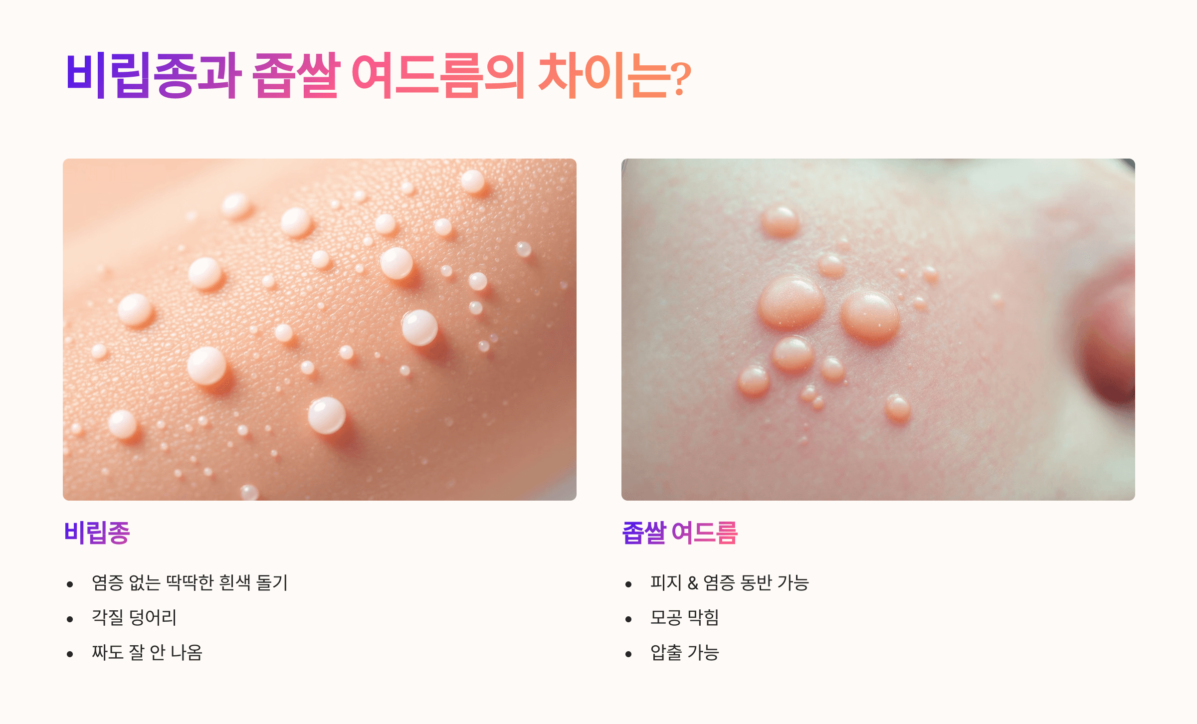 비립종과 관련된 사진입니다.