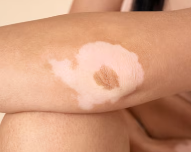 피부암 초기증상 20