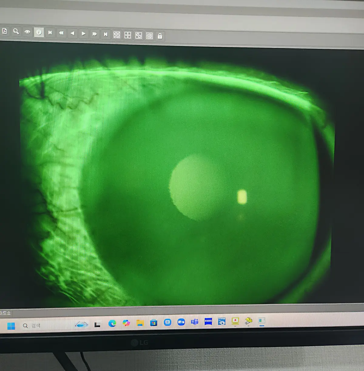 안구건조증-치료-후-사라진-각막미란-각막-상처들