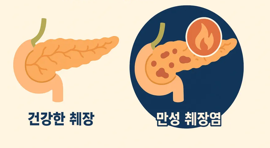 췌장암 원인