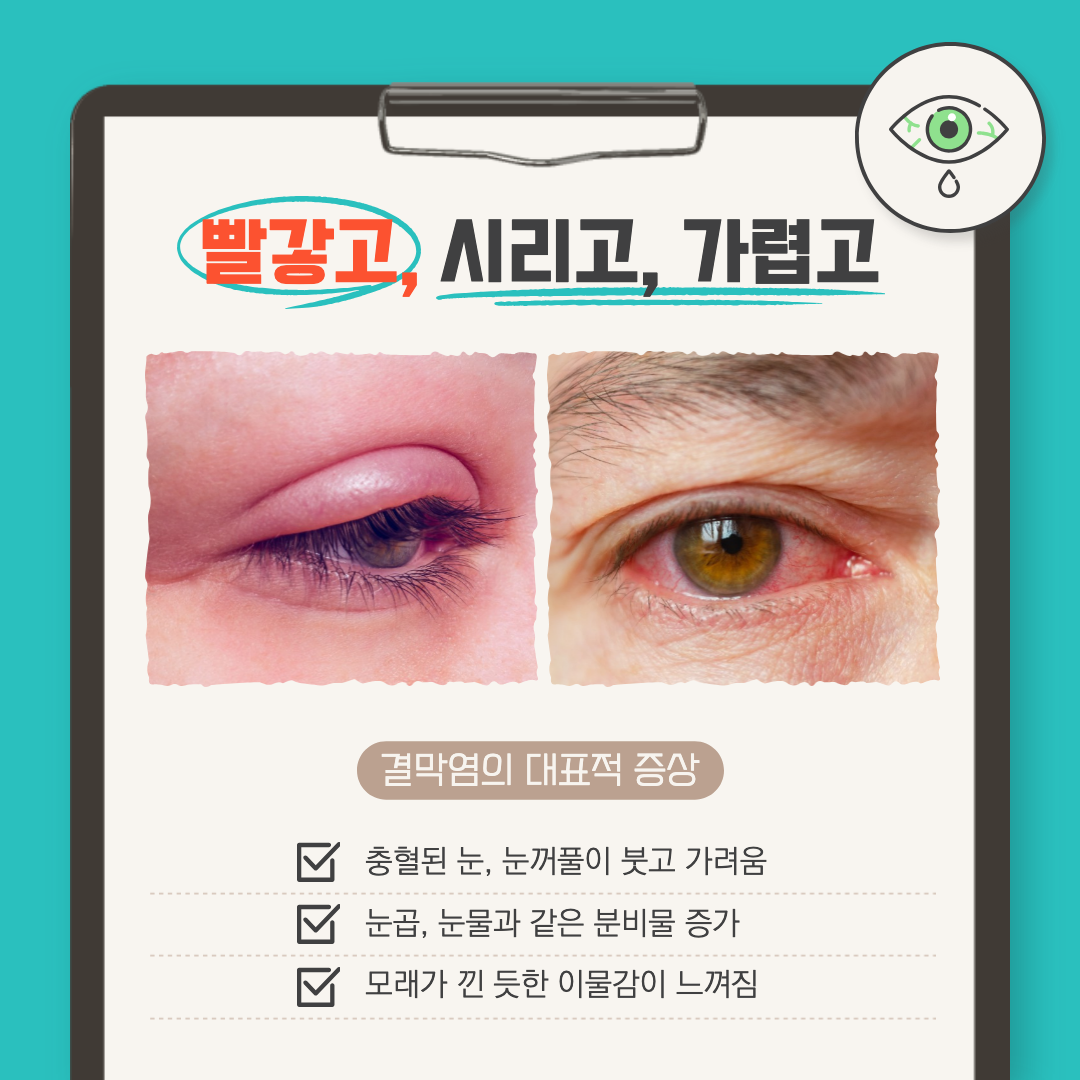 결막염의 증상 설명 이미지.