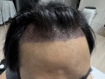 머리카락 이식 3000모 3000모낭 비용과 시술 과정_23
