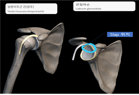 SLAP(superior labrum anterior to posterior)