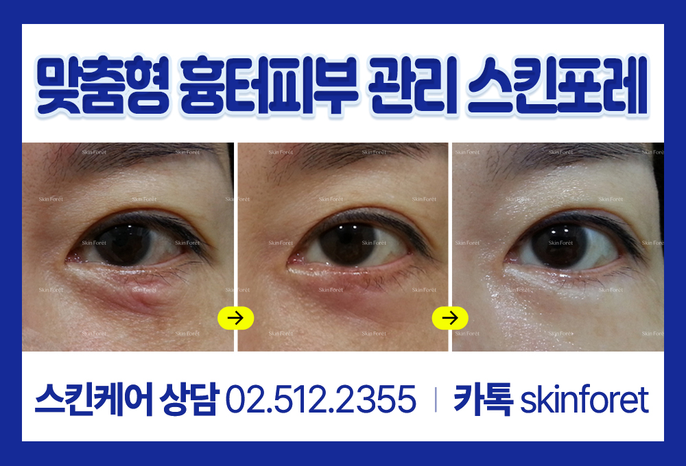 하안검수술로 인한 흉터 피부 관리 과정