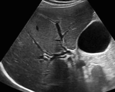 intrahepatic duct measurement(right)