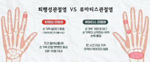 손가락 류마티스 관절염 증상