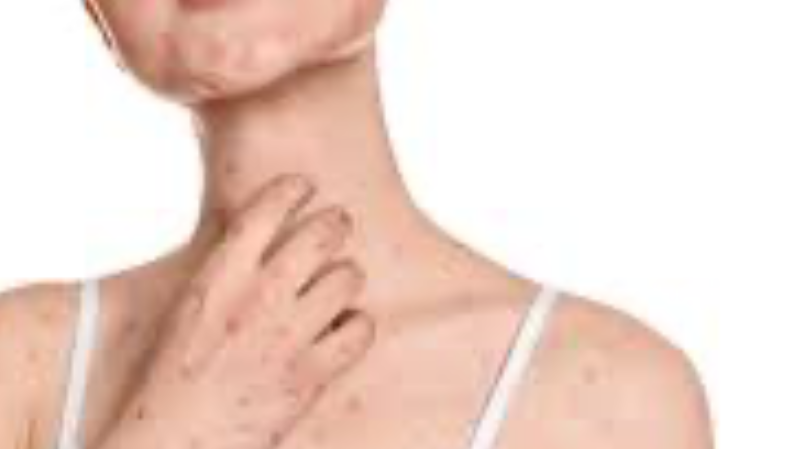 엠폭스-증상사진-감염경로