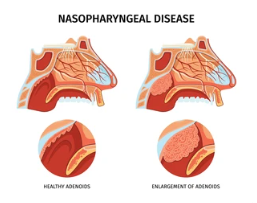 비인두암 기수별 생존율