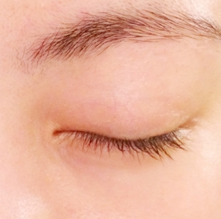 안검하수