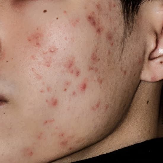 착색성 흉터 (Pigmented Scars): 원인과 효과적인 치료 방법