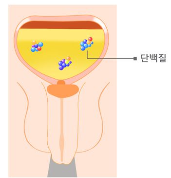요단백(단백뇨)치료법