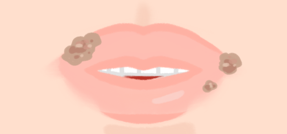 치유 단계