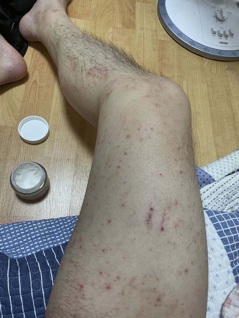 화이자 백신 접종 후 전신 두드러기와 피부 발진 가려움증