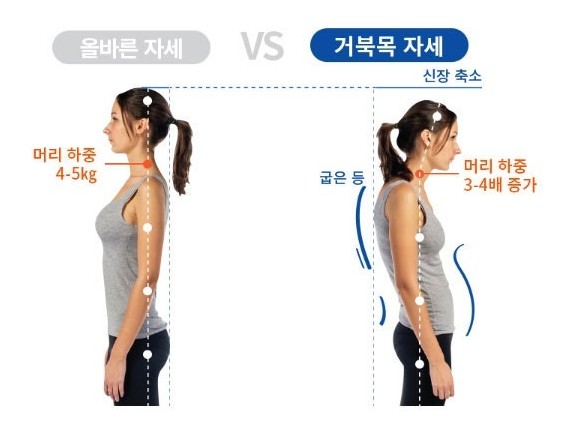 거북목 관련 사진