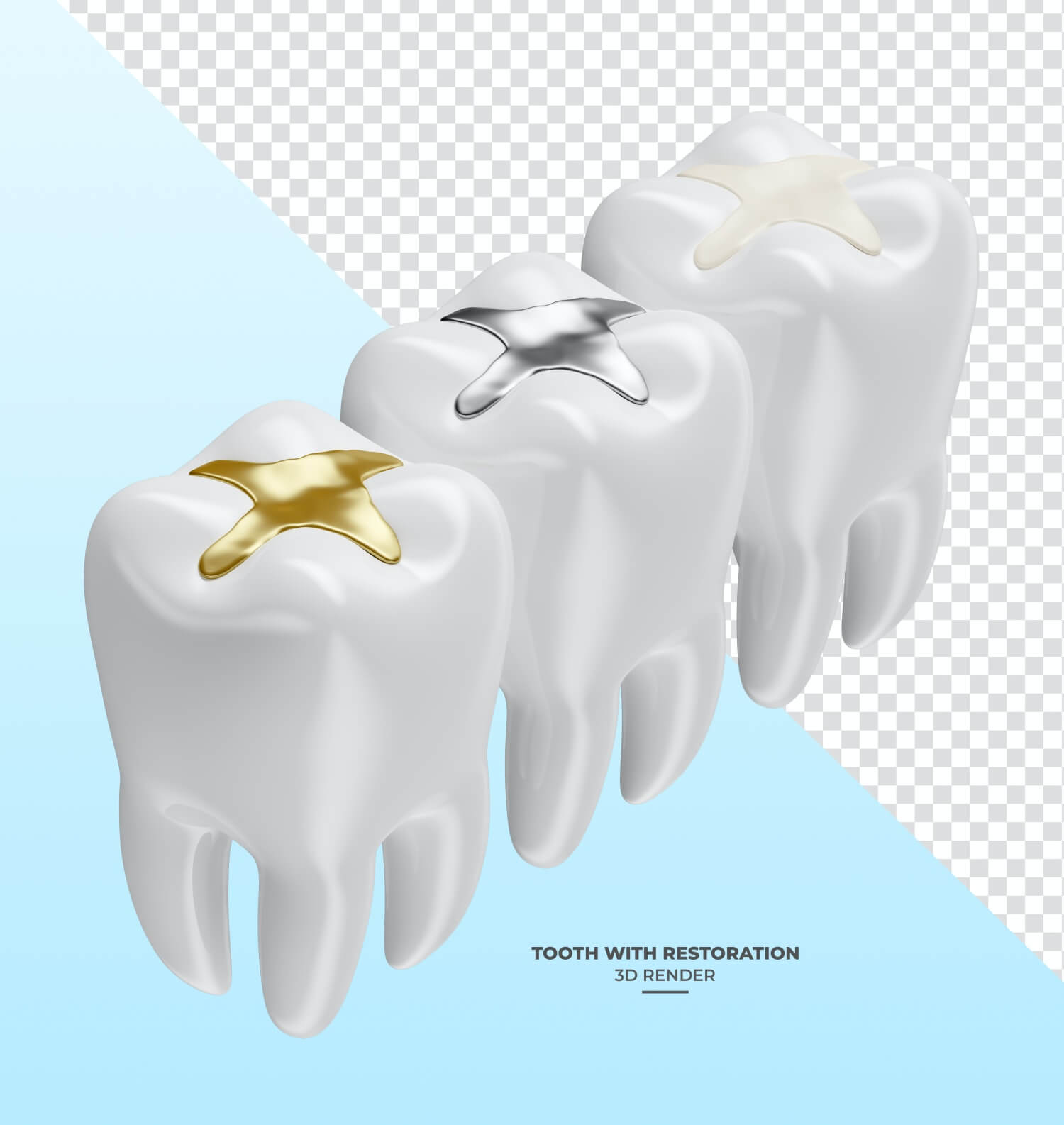 다양한-인레이-재료