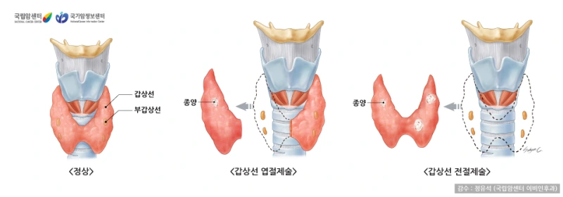 갑상선 유두암의 진단과 치료 방법