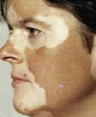 백반증 초기증상 23