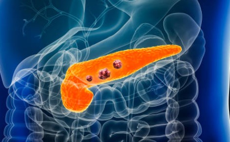 췌장암 초기증상