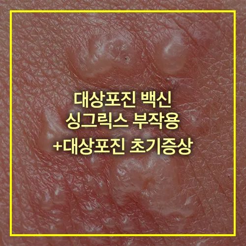 대상포진 싱그릭스 부작용 썸네일