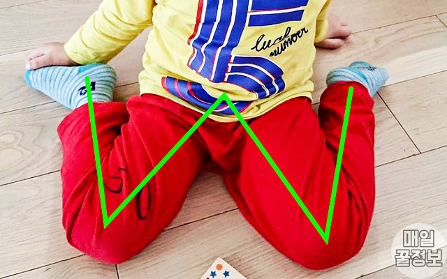 아기 w자세 골반