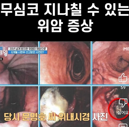 위암증상